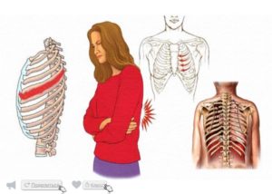 Ощущение давления на рёбра при межрёберной невралгии