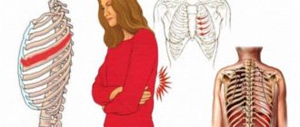 Ощущение давления на рёбра при межрёберной невралгии