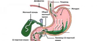 Хофитол при забросе желчи в желудок