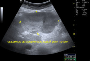 Объемное образование левой доли печени