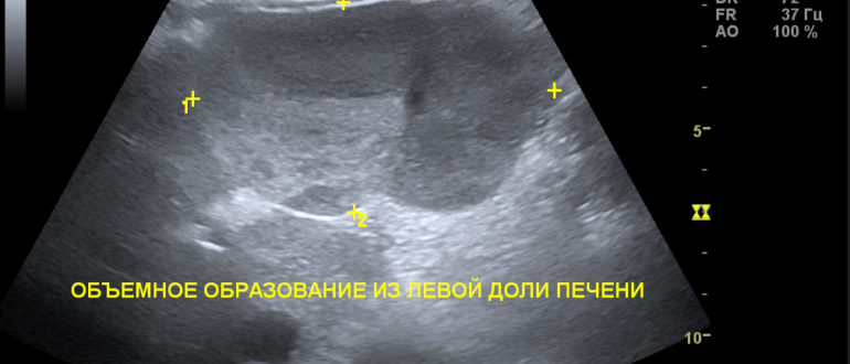 Объемное образование левой доли печени