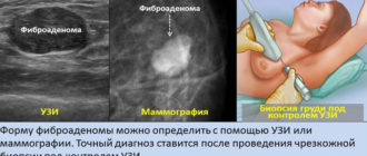 Фиброаденома! Требуется ли операция или можно пока наблюдать?