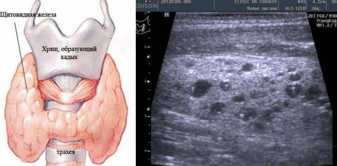 Очаговые диффузные изменения в щитовидной железе