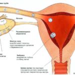 Осложнения биопсии шейки матки