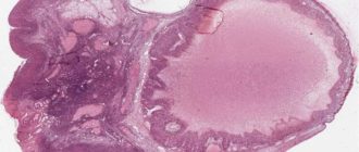 Гистология кисты яичника