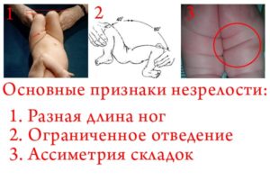 Незрелость тазобедренных суставов?