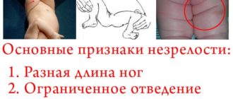 Незрелость тазобедренных суставов?