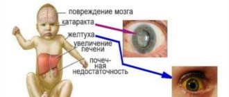 Галактоземия