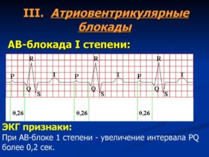 Неполная АВ-блокада 1 степени