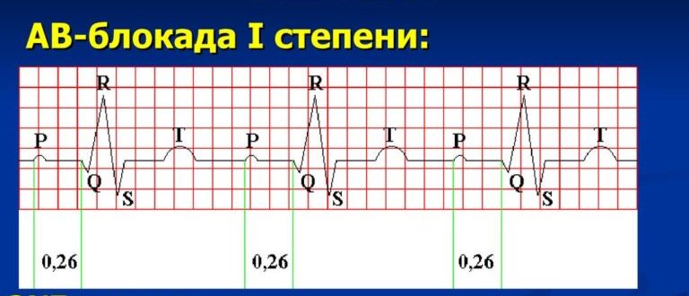 Неполная АВ-блокада 1 степени