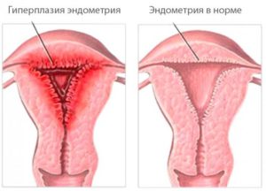 Гиперплазия эндометрия и эндометриоз