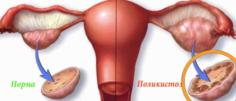 Гормоны при кисте яичника