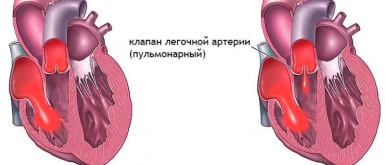 Незначительная регургитация на трикуспидальном клапане и клапане легочной артерии (1 степени