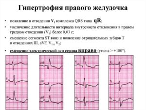 Гипертрофия левого желудочка и спорт