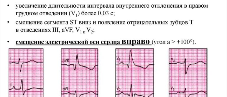 Гипертрофия левого желудочка и спорт