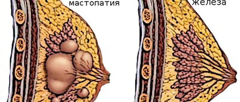 Фиброзно-кистозная мастопатия