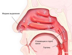 Острый риноаденоидит, аллергический ринит и препарат Монтелар