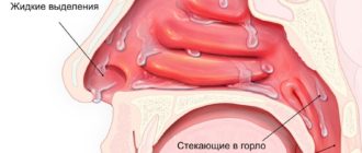 Острый риноаденоидит, аллергический ринит и препарат Монтелар