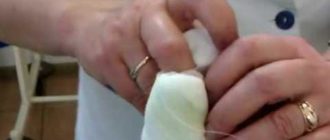 Панариций и послеоперационный уход