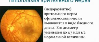 Гипоплазия дисков зрительного нерва