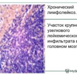 Отек десны после лечения зуба