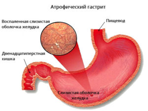 Хронический атрофический гастрит антрального отдела желудка