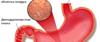 Хронический атрофический гастрит антрального отдела желудка