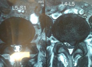 Нужно ли лечение рубцово-спаечного эпидурита на уровне диска L5/s1
