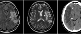 Образование в височной области