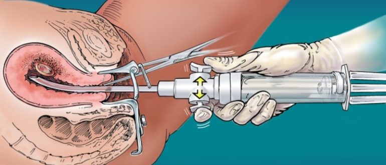 Не могу забеременеть после медикаментозного аборта
