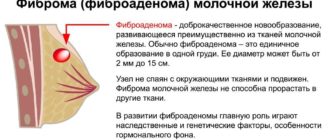 Фиброма груди в 14 лет