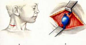 Флэбэктазия яремной вены у ребёнка
