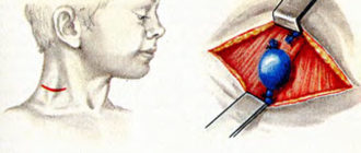 Флэбэктазия яремной вены у ребёнка