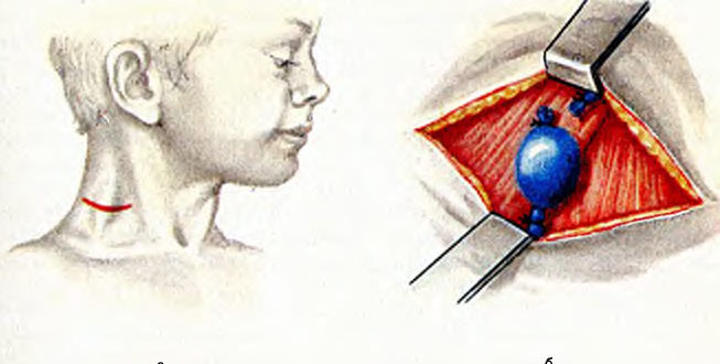 Флэбэктазия яремной вены у ребёнка
